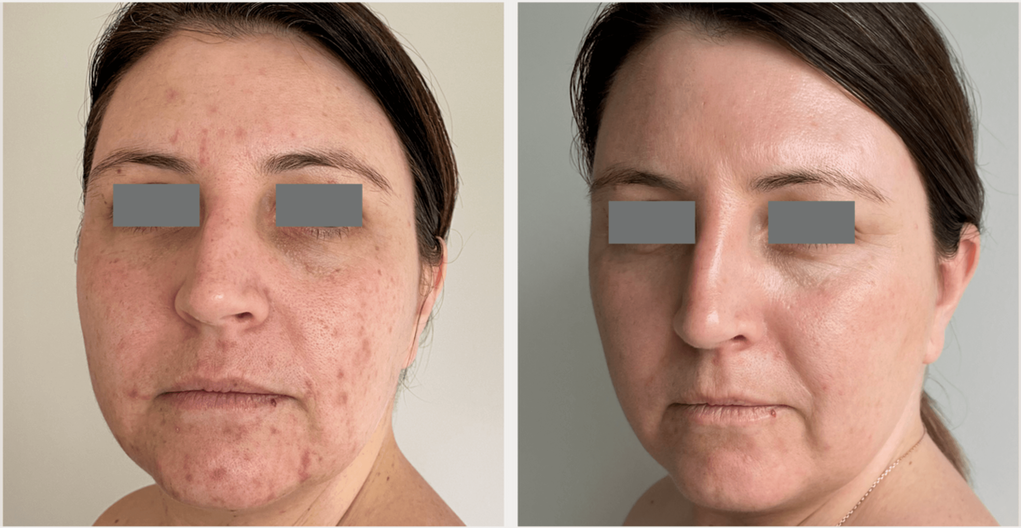 Before and after microneedling treatment