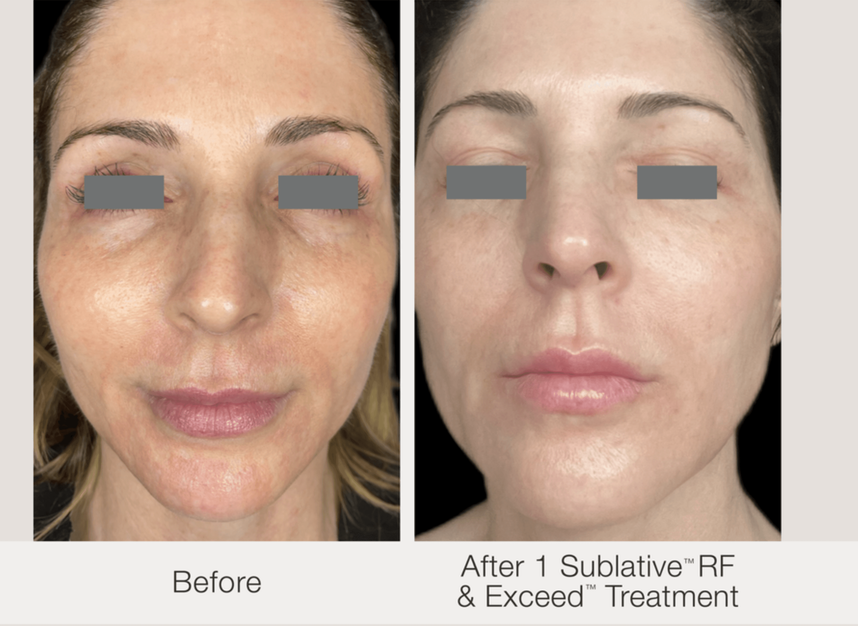 Before and after acne scar treatment