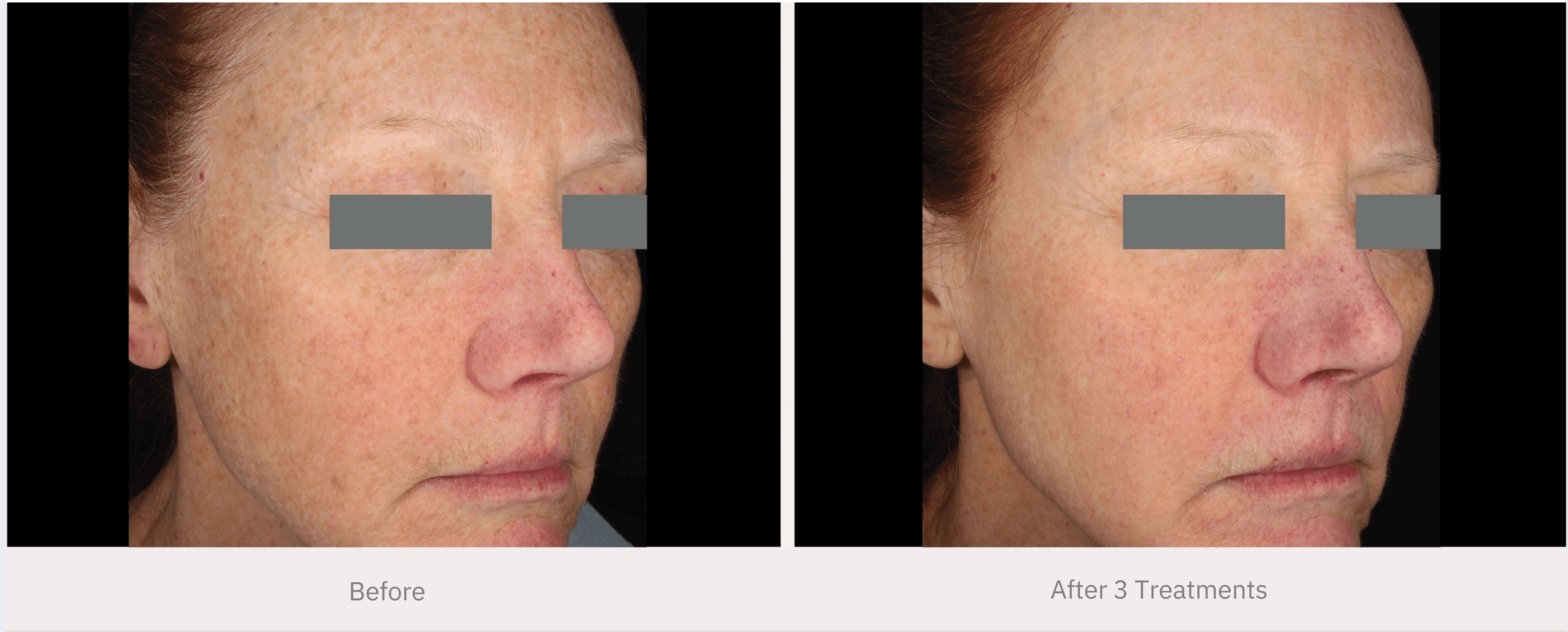 Before and after laser skin resurfacing