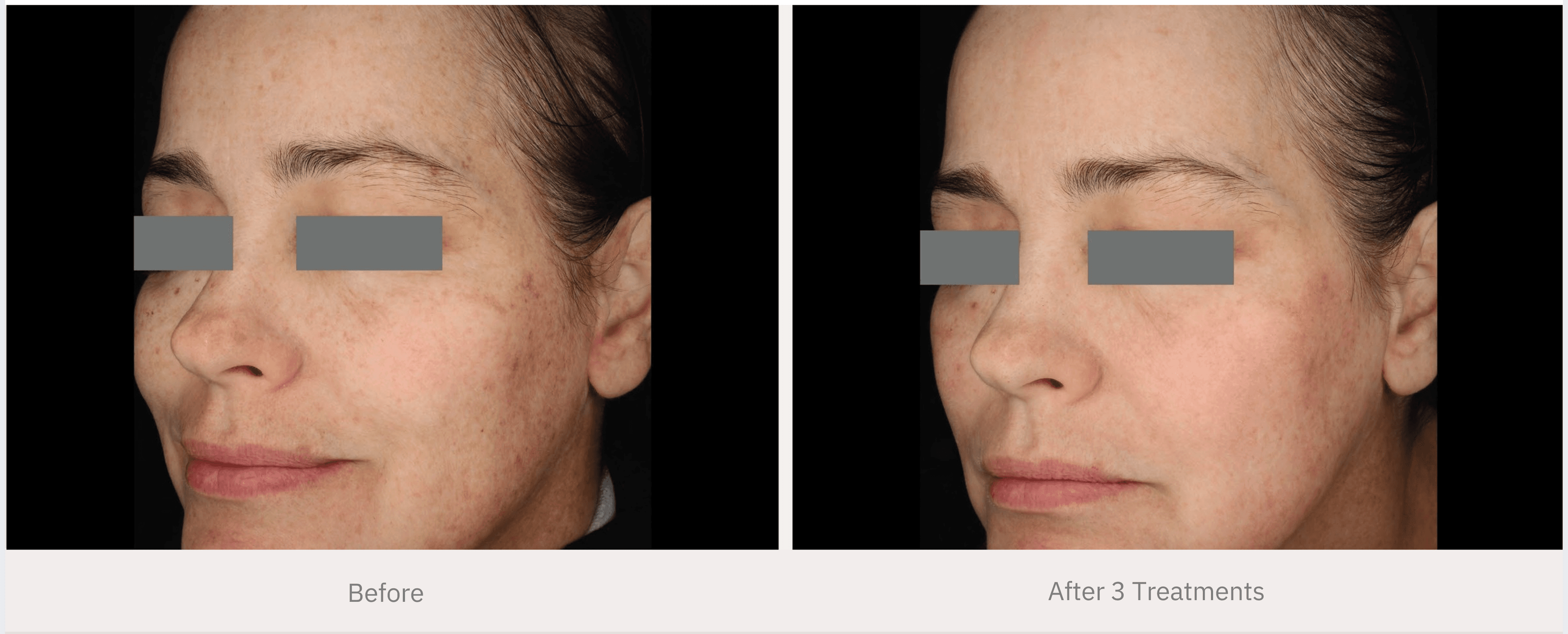 Before and after chemical peel facial