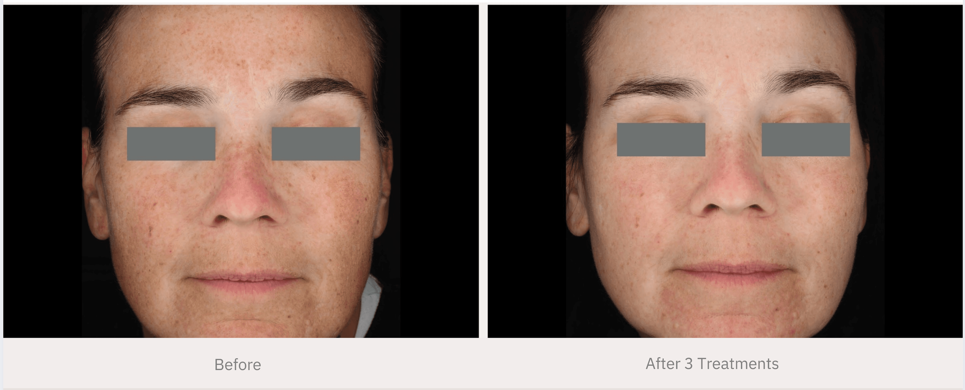 Before and after stretch mark reduction