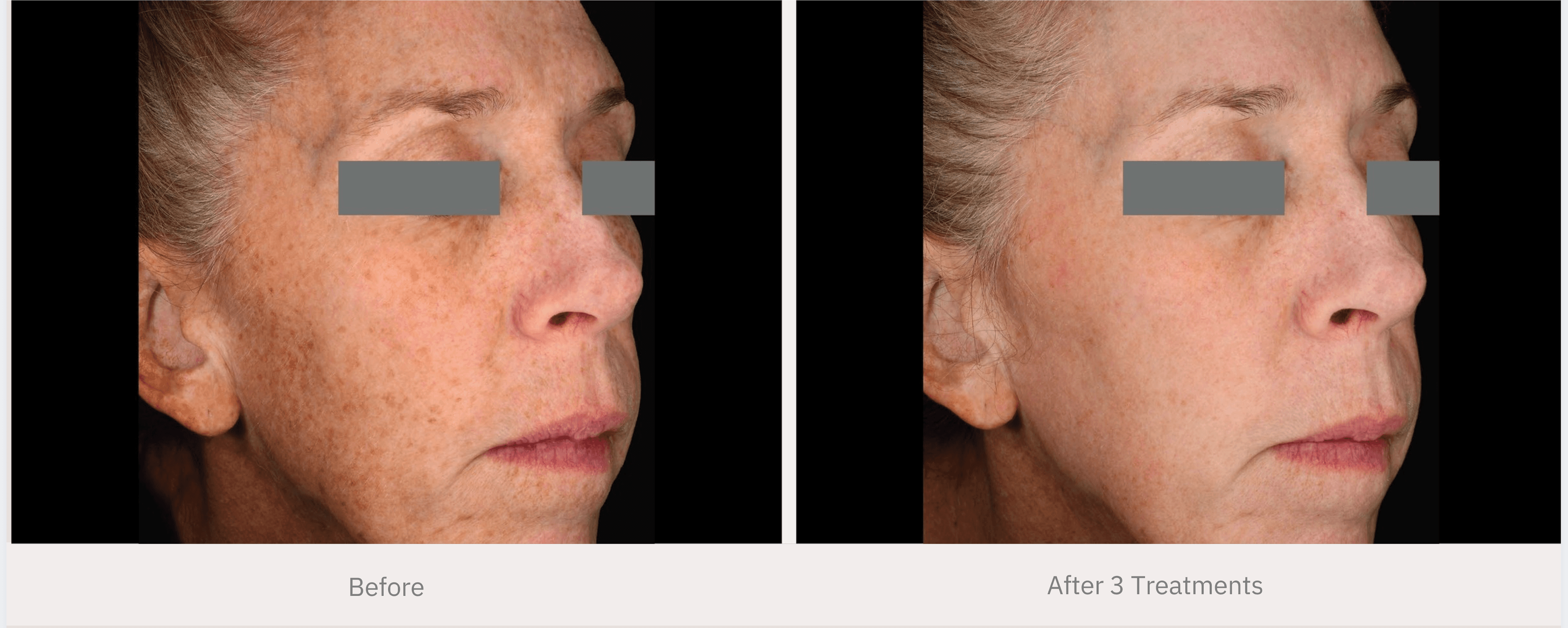 Before and after hyperpigmentation treatment