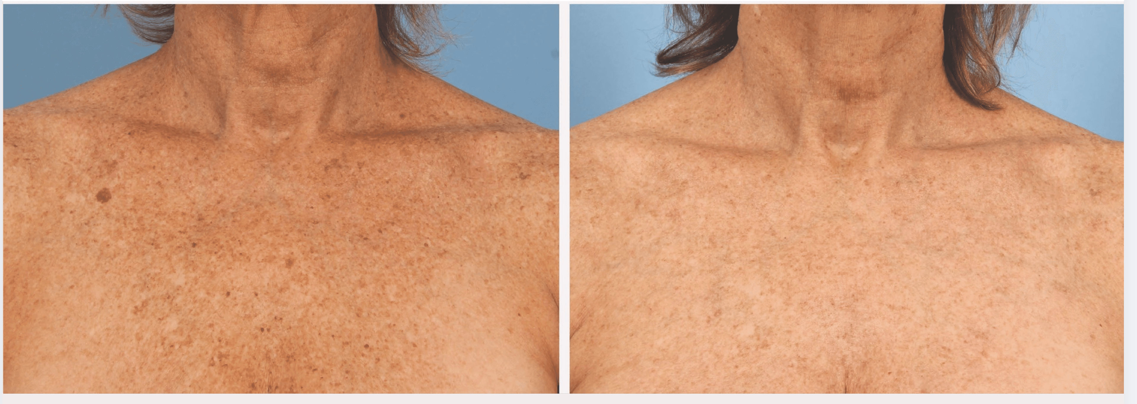 Before and after hydrafacial