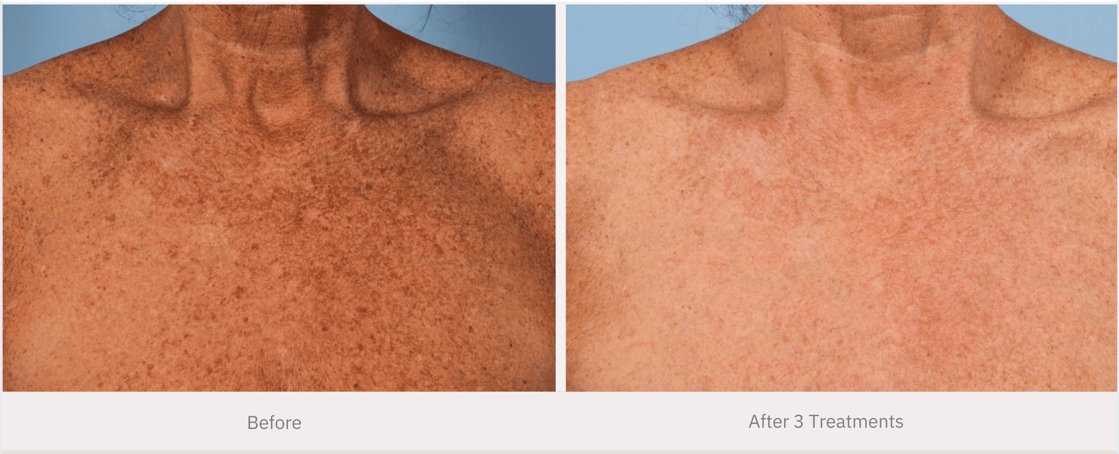 Before and after skin tightening