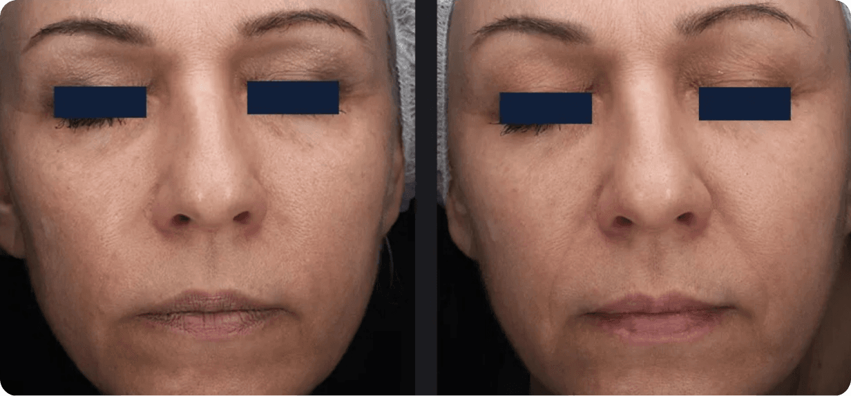 Before and after oxygen facial